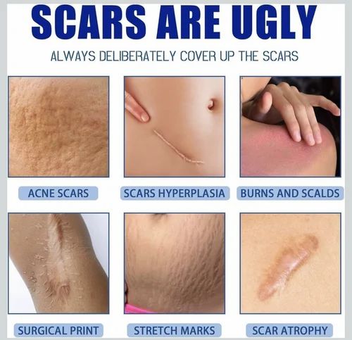 Scar Removal Cream 100g Each Pack Of 2
